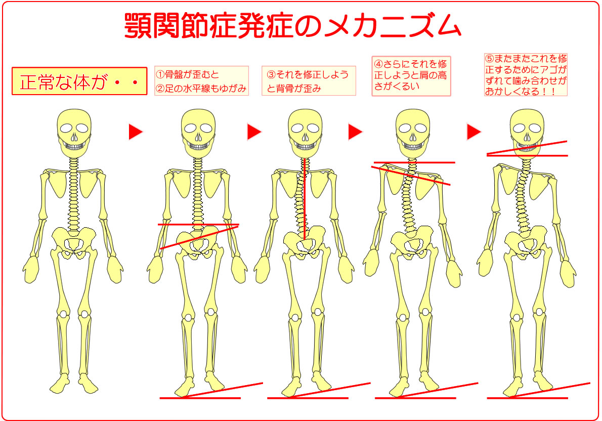 �{�֐ߏǔ��ǂ̃��J�j�Y���@����ȑ̂��@1.�����p�����ɂ�荜�Ղ��䂪�ނƁ@2.���̐��������c�݁@3.������C�����悤�Ɣw�����c�݁@4.����ɂ�����C�����悤�ƌ��̍��������邢�@5.������C�����邽�߂Ɋ{���Y�����ݍ��킹�������Ȃ�̂ł�